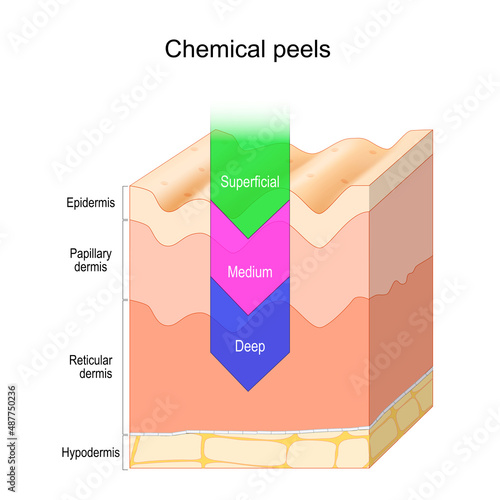Chemical peel. Skin layers photo