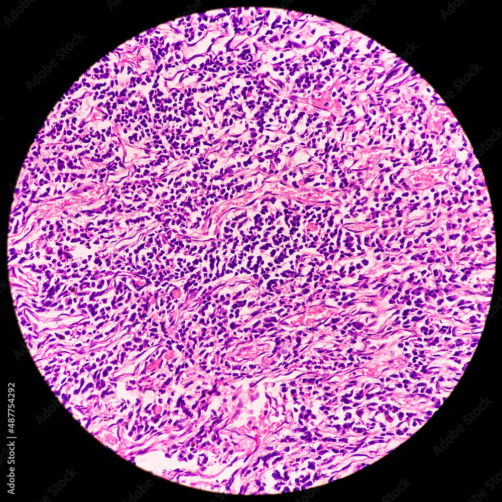 Fotografia do Stock Breast biopsy Invasive ductal carcinoma high