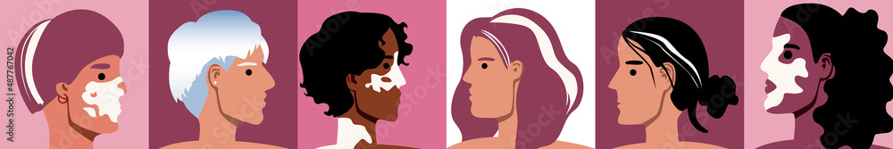 Different women with vitiligo skin as collage, flat vector stock illustration with depigmentation appearance