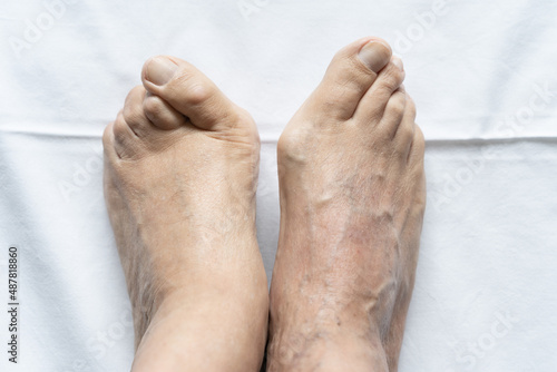 Feet of senior man together with big bunions and hammer toes on the floor. Medical surgery, health care, podiatrist, dermatology concepts