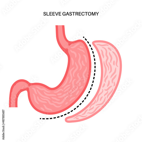 Laparoscopic sleeve gastrectomy
