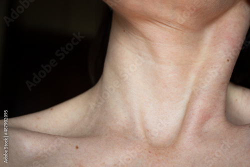 age-related changes in the neck and d  collet    age spots  wrinkles  skin aging