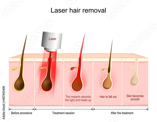 Laser hair removal