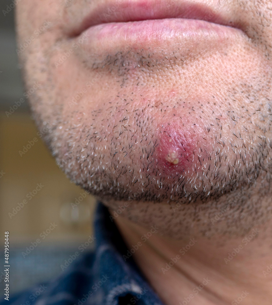Obraz premium single acne on the chin, inflamed large acne, single large acne on a man's face,