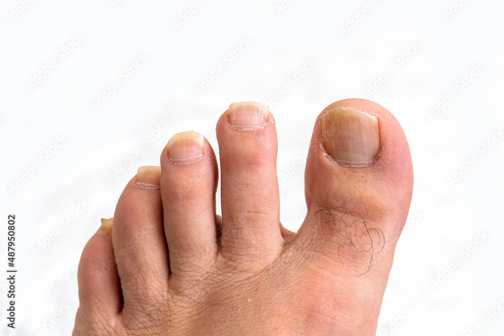 cutting toenails,a person toenails growing too long,extended toenails close-up, cutting toenails,a person toenails growing too long,extended toenails close-up,