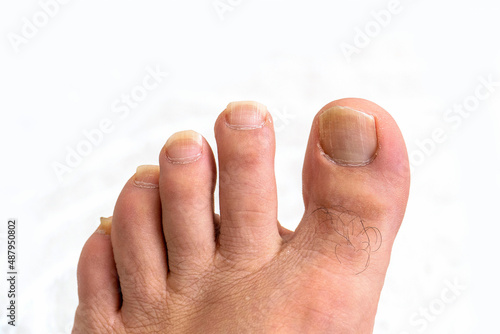 cutting toenails,a person toenails growing too long,extended toenails close-up,