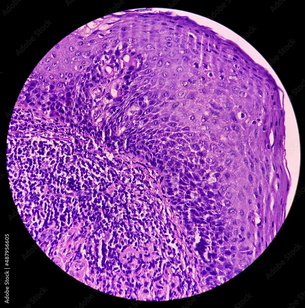 Chronic tonsillitis: Microscopic image of tonsillar tissue, show ...