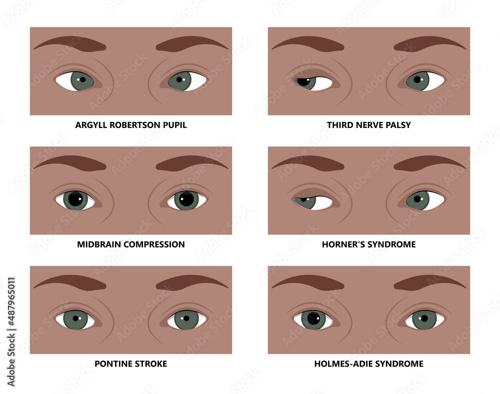 miosis eye pupil size iris retina brain Horner miotic muscle dilated