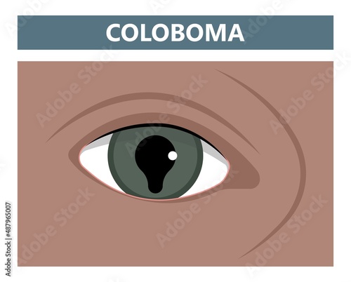 miosis eye pupil size iris retina brain Horner miotic muscle dilated ocular injury ptosis reflex Marcus Gunn defect optic nerve test palsy Trauma birth Adie tonic argyll hutchinson blind diplopia exam