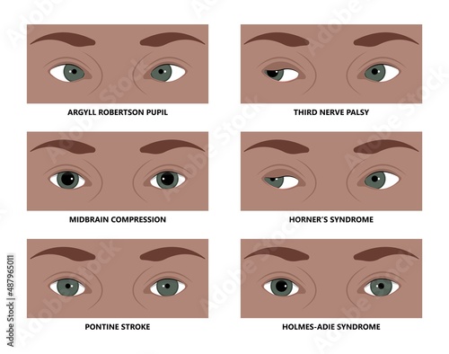 miosis eye pupil size iris retina brain Horner miotic muscle dilated ocular injury ptosis reflex Marcus Gunn defect optic nerve test palsy Trauma birth Adie tonic argyll hutchinson blind diplopia exam