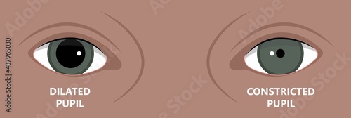 miosis eye pupil size iris retina brain Horner miotic muscle dilated ocular injury ptosis reflex Marcus Gunn defect optic nerve test palsy Trauma birth Adie tonic argyll hutchinson blind diplopia exam