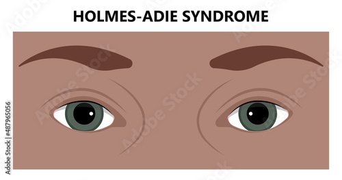 miosis eye pupil size iris retina brain Horner miotic muscle dilated ocular injury ptosis reflex Marcus Gunn defect optic nerve test palsy Trauma birth Adie tonic argyll hutchinson blind diplopia exam