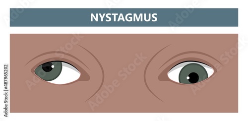 miosis eye pupil size iris retina brain Horner miotic muscle dilated ocular injury ptosis reflex Marcus Gunn defect optic nerve test palsy Trauma birth Adie tonic argyll hutchinson blind diplopia exam