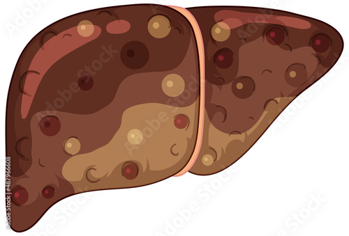 Fibrosis liver on white background