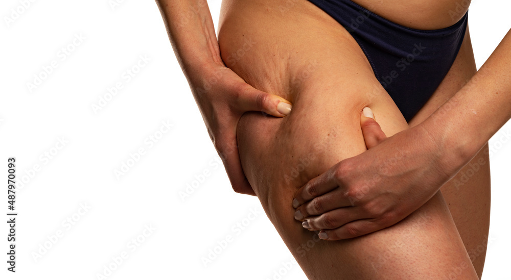 woman body care lifestyle concept of leg with wrinkled skin and cellulite