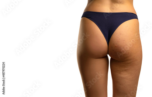 Female buttocks before and after treatment photo
