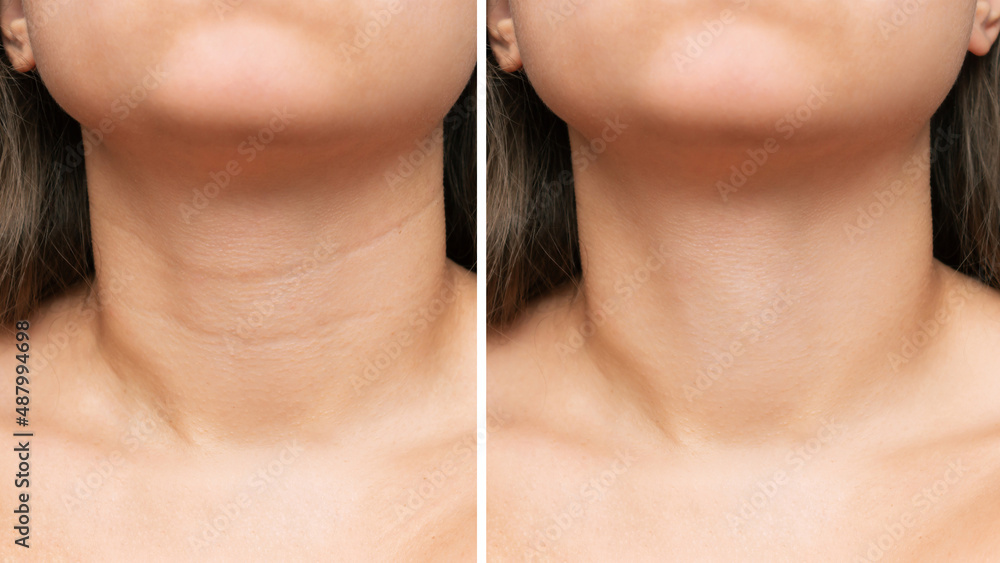 Сlose-up of young woman's neck with wrinkles before and after treatment.  Result of cosmetic rejuvenating procedures. Lines, age-related changes,  Venus rings. Neck lift, collagen injections, skin care Stock Photo | Adobe  Stock