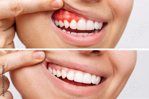 Two shots of a young woman with red bleeding gums and health gums, before and after treatment isolated on a white background. Result of curing of gum inflammation. Close up. Dentistry, dental care