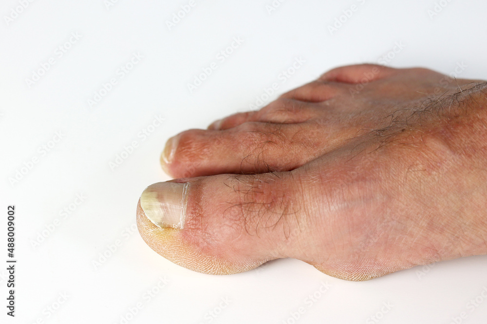 Close up fungus toenail disease, the fungus infects the areas between