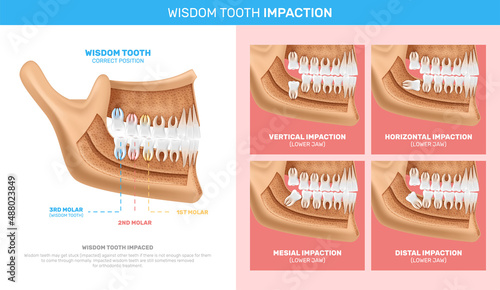 Wisdom Tooth Impaction Infographics photo