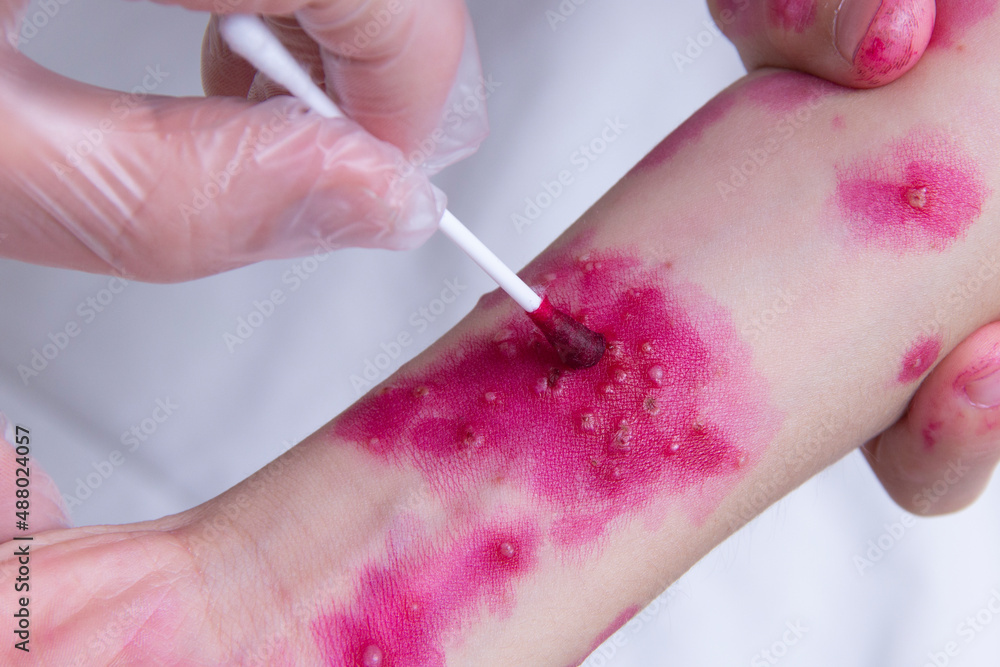 Fototapeta premium The skin rash in a child is treated with a cotton swab. Chickenpox virus. Skin rash and blisters on the body