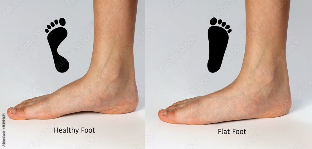 Normal neutral healthy foot compare with flat foot or fallen arch problem  with Foot print to show how entire sole of the foot to touch the floor when  stand up. Stock Photo