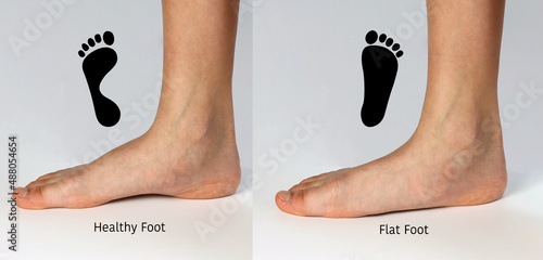 Normal neutral healthy foot compare with  flat foot or fallen arch problem with Foot print to show how entire sole of the foot to touch the floor when stand up. © Praewphan
