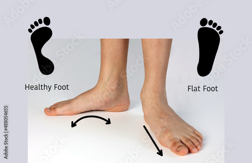 Normal neutral healthy foot compare with  flat foot or fallen arch problem with Foot print to show how entire sole of the foot to touch the floor when stand up. photo