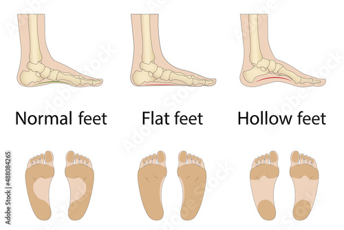 Foot deformity types, medical disease infographics. Hollow, flat, and normal foot. Vector Illustration