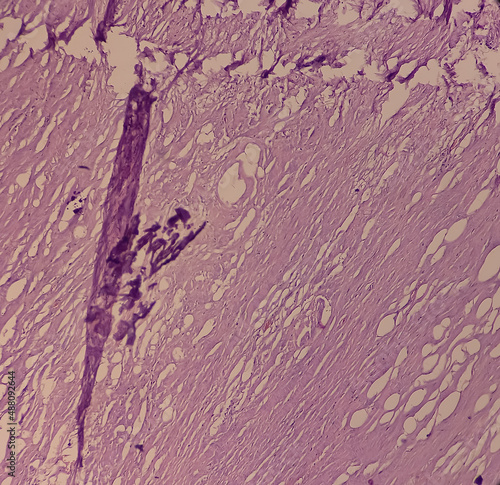 Calcinosis cutis(subcutis): microscopic view show fibrocollagenous tissue and areas of calcification, histopathology, microscopic 40x view. photo