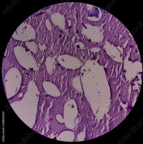 Calcinosis cutis(subcutis): microscopic view show fibrocollagenous tissue and areas of calcification, histopathology, microscopic 40x view. photo