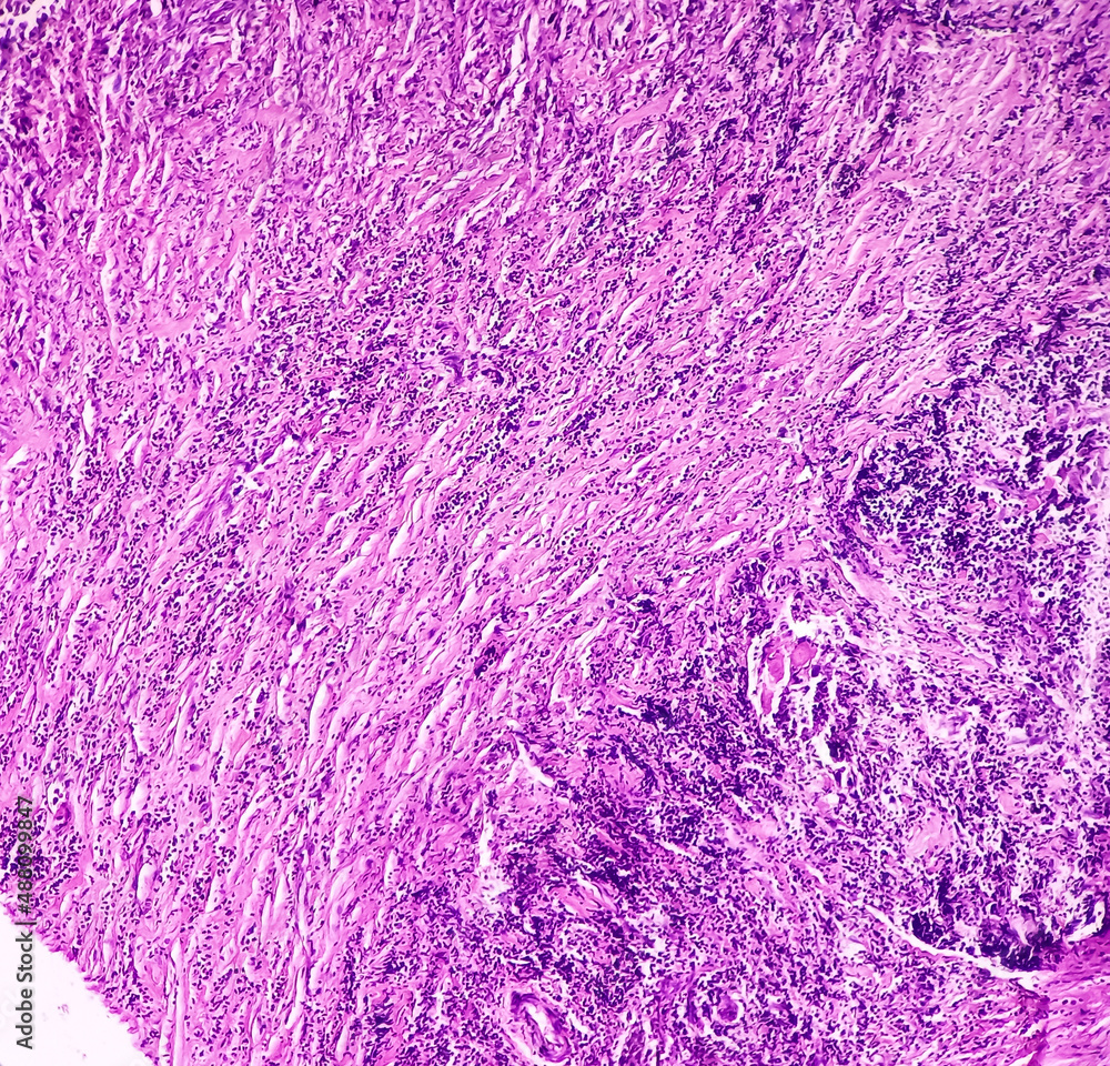 of gallbladder(CSGB), show malignant neoplasm, atypical
