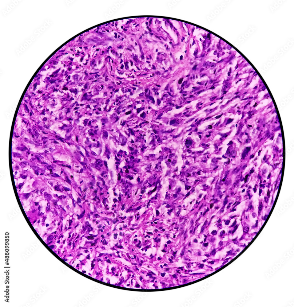 of gallbladder(CSGB), show malignant neoplasm, atypical