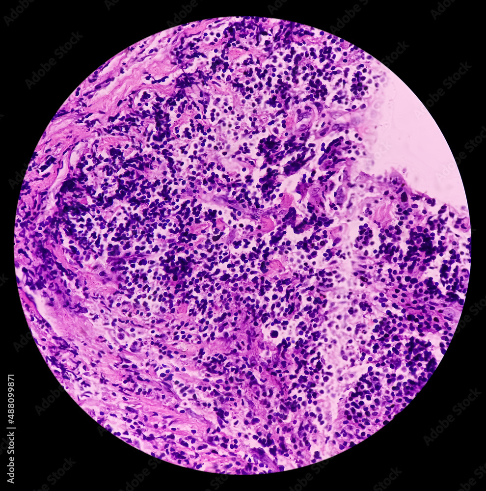 of gallbladder(CSGB), show malignant neoplasm, atypical