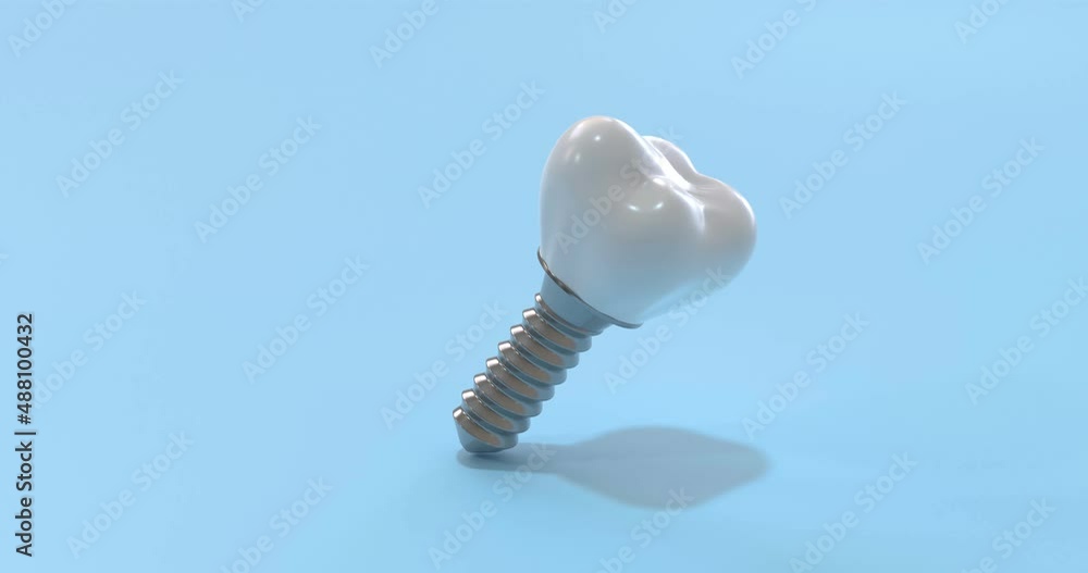 Tooth prosthesis, implant, rotation along its axis on a blue background. 3d render. Looped 4k video Tooth prosthesis, implant, rotation along its axis on a blue background. 3d render. Looped 4k video