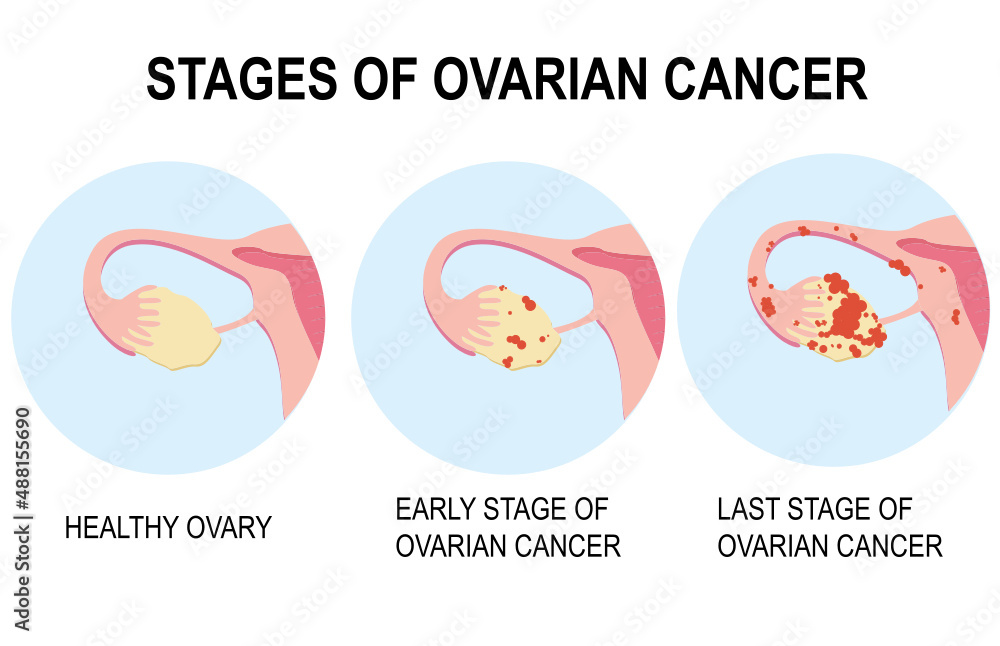 Fototapeta Diagram showing stages of ovarian cancer illustration. Pelvic cancer PCOS of the