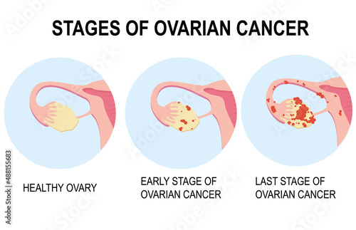 Diagram showing stages of ovarian cancer illustration. Pelvic cancer PCOS of the ovary. Ovarian cyst, polyp, pregnancy, fertility problems, female reproductive system, disease. Infographics, flat. photo