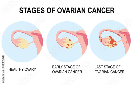 Diagram showing stages of ovarian cancer illustration. Pelvic cancer PCOS of the ovary. Ovarian cyst, polyp, pregnancy, fertility problems, female reproductive system, disease. Infographics, flat.