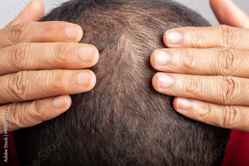 male pattern baldness hair loss or visible scalp photo