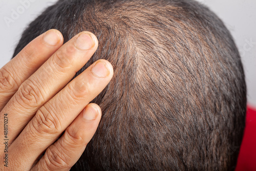 worried man showing visible hair loss scalp or thinning hair photo