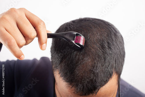 male pattern baldness treatment by dermaroller therapy photo