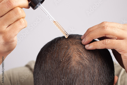 essential hair oil treatment for androgenetic alopecia hair loss photo