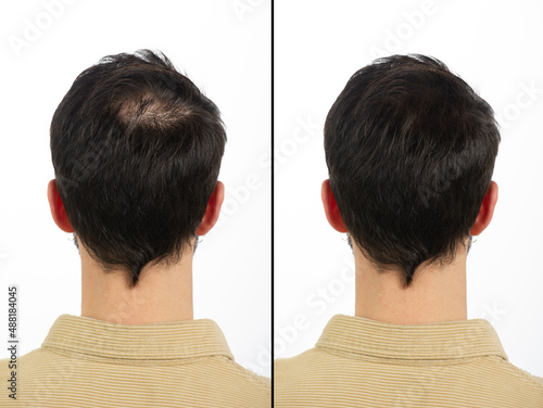 Εκτύπωση καμβά Nape of a young man with baldness principle before and after treatment