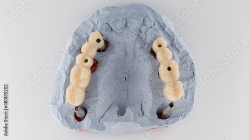 Photos dental prostheses bridge for orthopedics in the masticatory area, top view on a