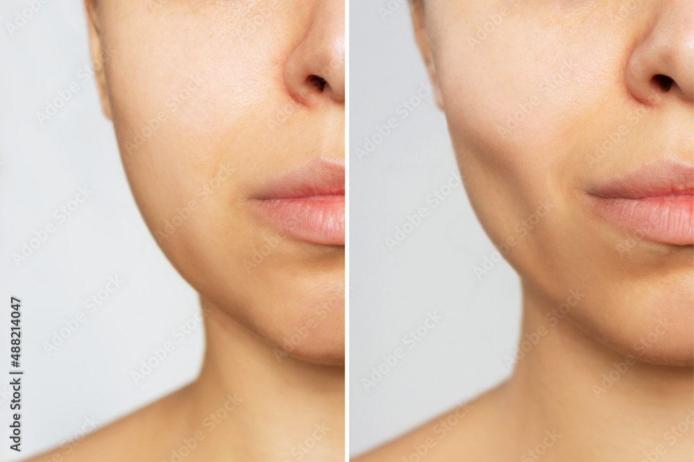 Obraz premium Cropped shot of young woman's face before and after plastic surgery buccal fat pad removal on a white background. A lower part of face with clear highlighted cheekbones. Result of cosmetic surgery