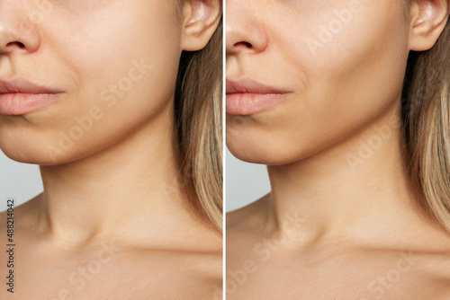 Cropped shot of young woman's face before and after plastic surgery buccal fat pad removal. A lower part of face with clear highlighted cheekbones. Result of cosmetic surgery