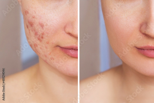 Bild auf Leinwand Cropped shot of a young woman's face before and after acne treatment