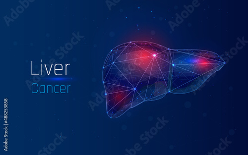 Cirrhosis or liver cancer or other disease. Medical concept in
Wireframe style with triangles and dots