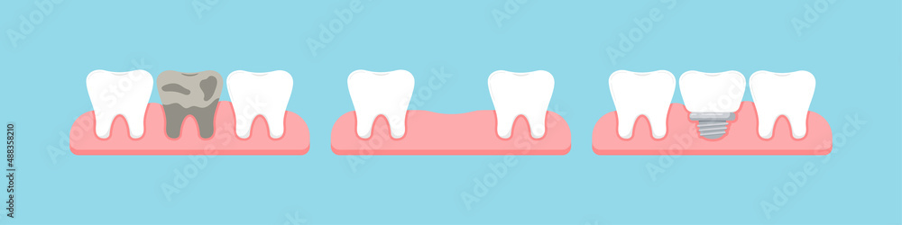Tooth Defects Animation Dead tooth, lost stage and dental implant in gum isolated on blue ...