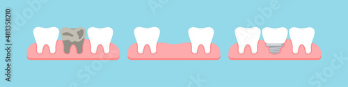 Dead tooth, lost stage and dental implant in gum isolated on blue background. Healthy human teeth and implant prosthesis concept. Flat design cartoon style vector orthodontist dentistry illustration.